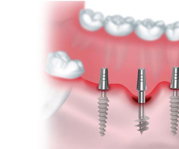 Basal Implants vs Conventional Implants for Seniors