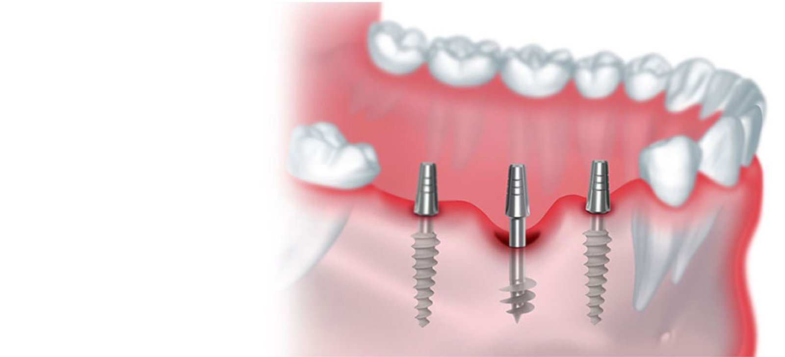 Basal Implants vs Conventional Implants for Seniors