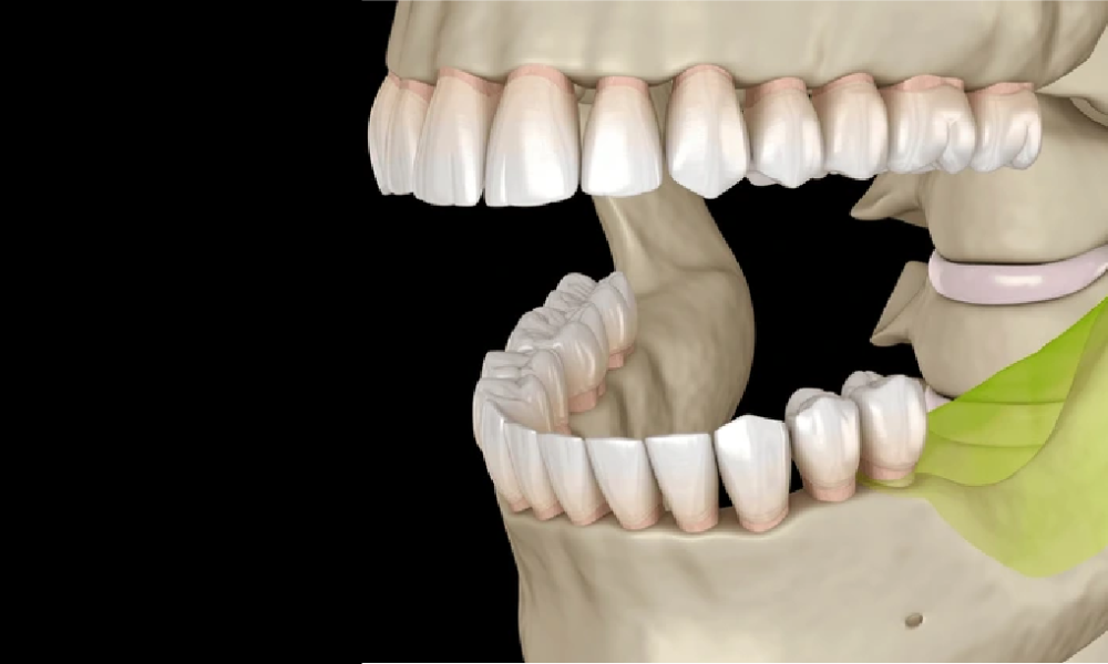 Elderly Jawbone Loss Treatment in Pune