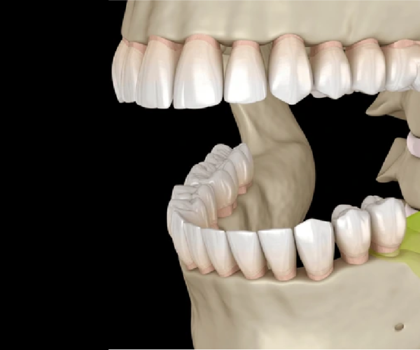 Elderly Jawbone Loss Treatment in Pune